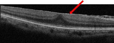 黄斑前膜のOCT画像