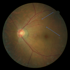 矢印で挟まれた領域は緑内障により視神経の薄くなった網膜で、他の正常網膜よりやや暗く見えます